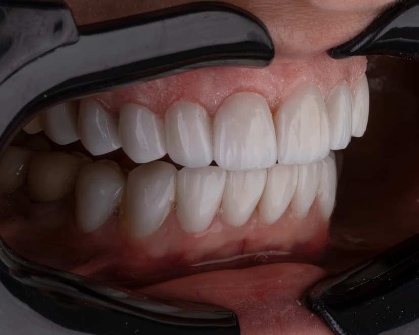 Invisalign Before After Comparison