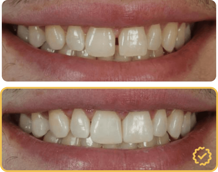 Composite Bonding