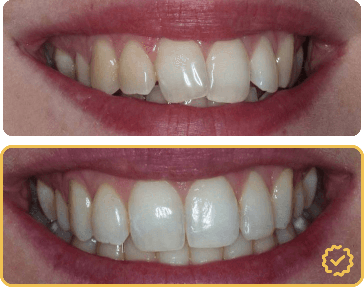 Invisalign Before After Comparison