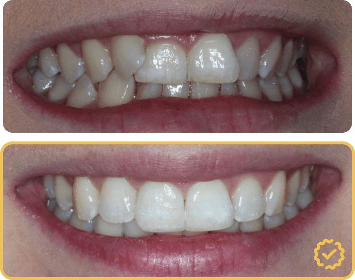 Invisalign Before After Comparison