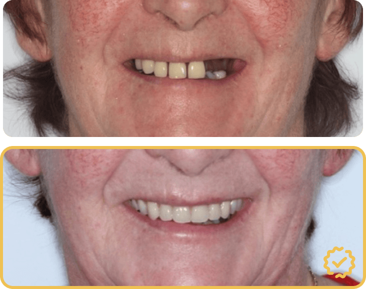 All on Four Upper Implants