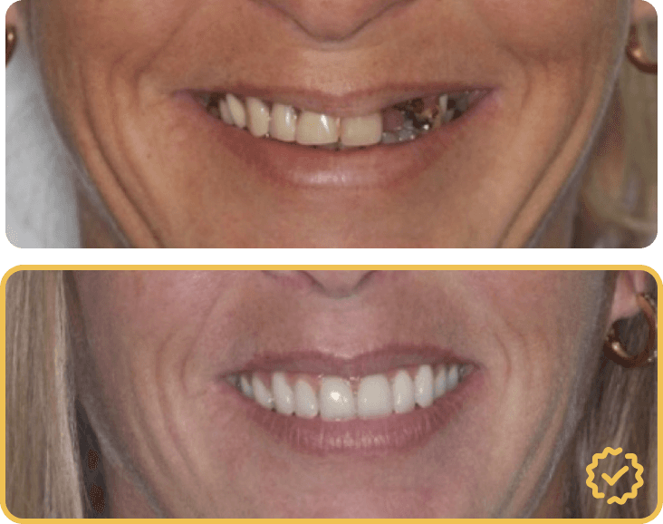All on Four Upper Implants